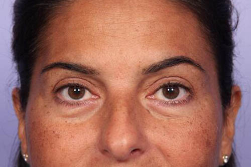 Eyelid Surgery Before & After Image