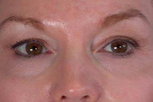 Eyelid Surgery Before & After Image