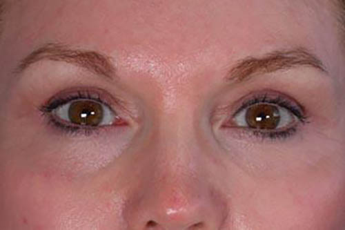 Eyelid Surgery Before & After Image