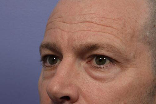 Eyelid Surgery Before & After Image