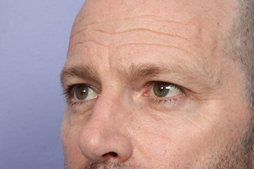 Eyelid Surgery Before & After Image