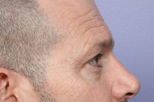 Eyelid Surgery Before & After Image