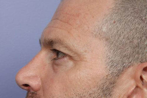 Eyelid Surgery Before & After Image