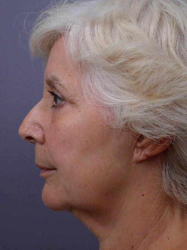 Eyelid Surgery Before & After Image