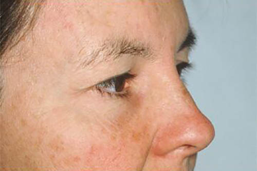 Eyelid Surgery Before & After Image