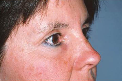 Eyelid Surgery Before & After Image