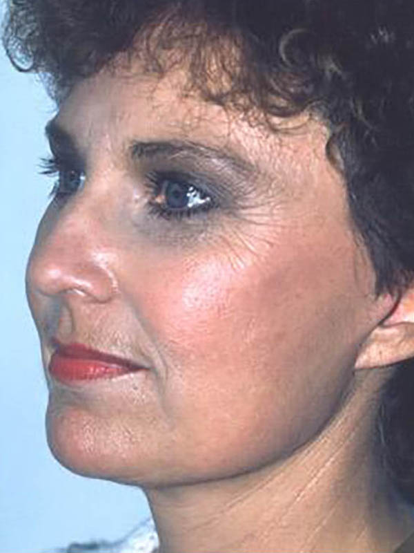 Eyelid Surgery Before & After Image