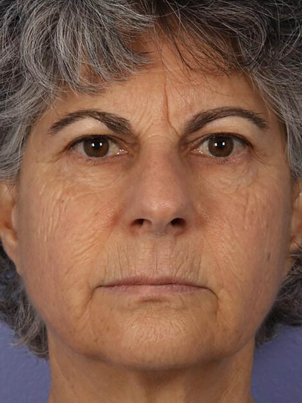 Eyelid Surgery Before & After Image