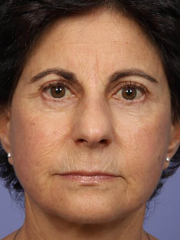 Eyelid Surgery Before & After Image