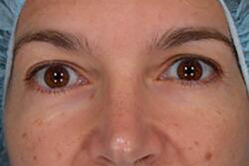 Eyelid Surgery Before & After Image