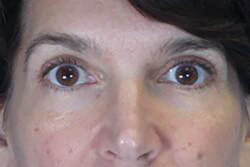 Eyelid Surgery Before & After Image