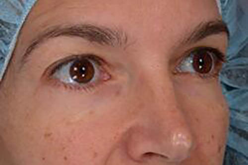 Eyelid Surgery Before & After Image