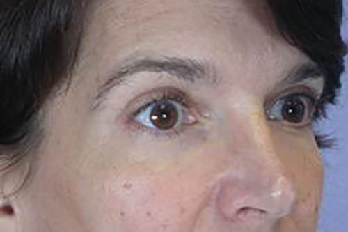 Eyelid Surgery Before & After Image