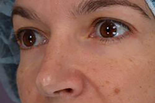 Eyelid Surgery Before & After Image