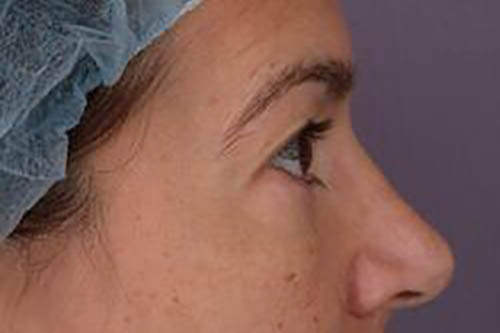 Eyelid Surgery Before & After Image