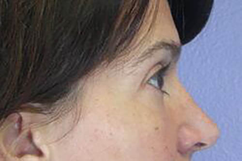 Eyelid Surgery Before & After Image