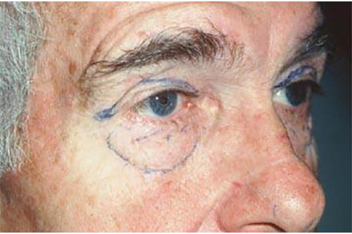 Eyelid Surgery Before & After Image