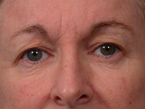 Eyelid Surgery Before & After Image