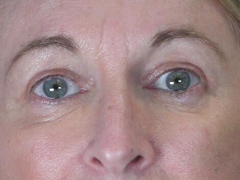 Eyelid Surgery Before & After Image