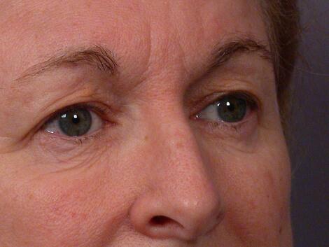 Eyelid Surgery Before & After Image