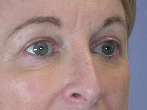 Eyelid Surgery Before & After Image