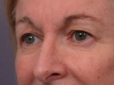 Eyelid Surgery Before & After Image