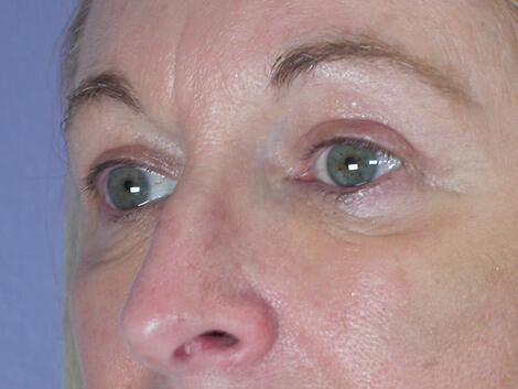 Eyelid Surgery Before & After Image