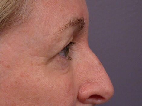 Eyelid Surgery Before & After Image