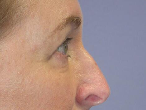 Eyelid Surgery Before & After Image