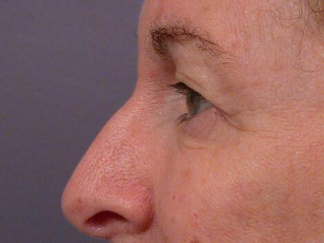 Eyelid Surgery Before & After Image