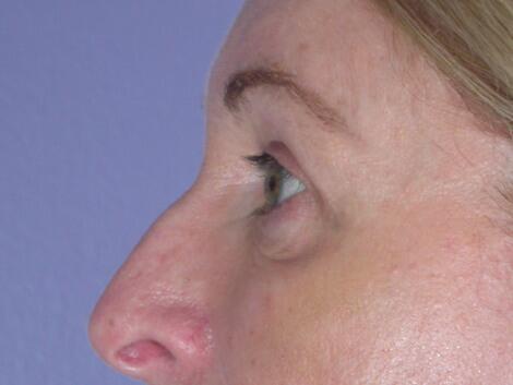 Eyelid Surgery Before & After Image