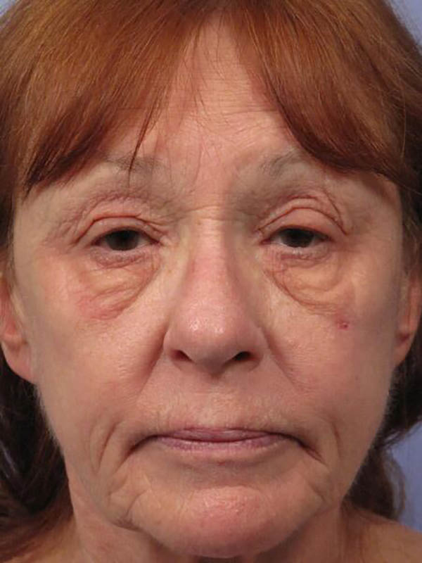 Eyelid Surgery Before & After Image