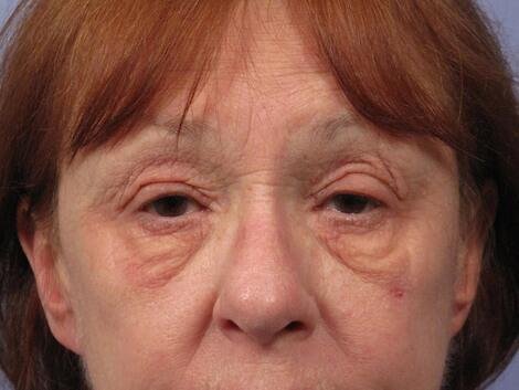 Eyelid Surgery Before & After Image