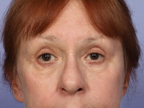 Eyelid Surgery Before & After Image