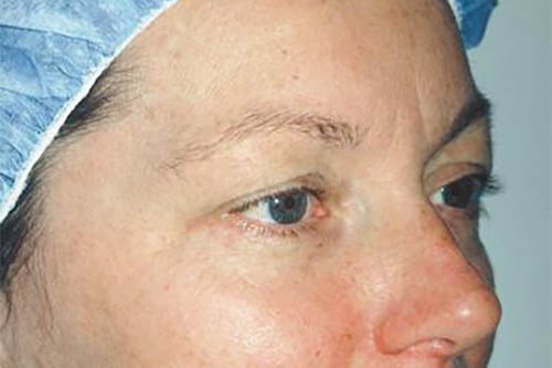 Eyelid Surgery Before & After Image