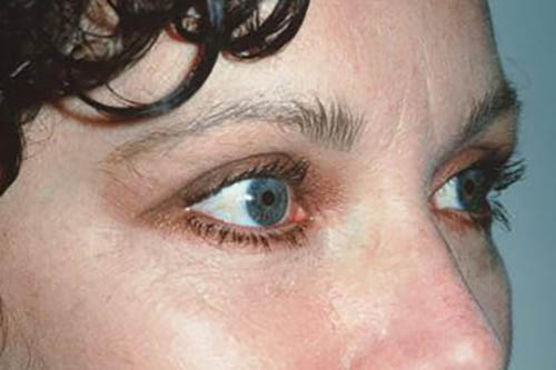 Eyelid Surgery Before & After Image