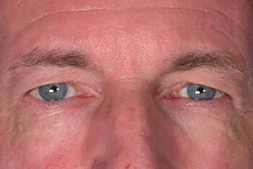 Eyelid Surgery Before & After Image