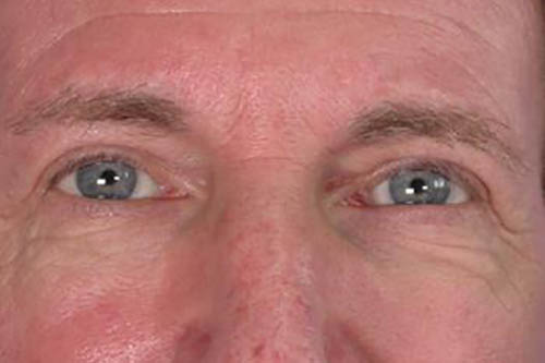 Eyelid Surgery Before & After Image