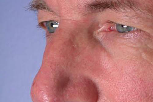 Eyelid Surgery Before & After Image