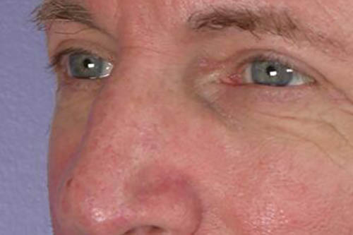 Eyelid Surgery Before & After Image