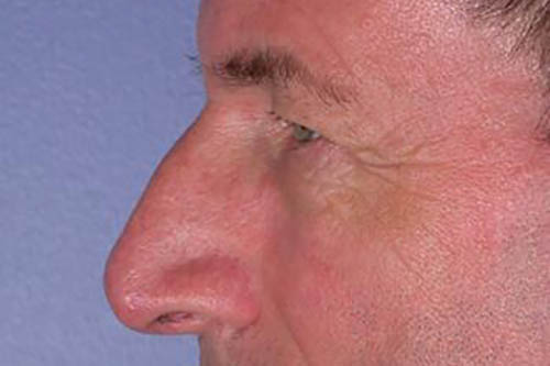 Eyelid Surgery Before & After Image