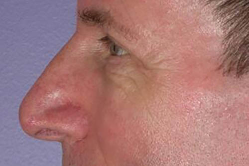 Eyelid Surgery Before & After Image