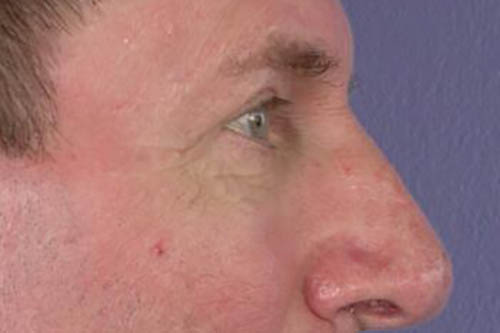 Eyelid Surgery Before & After Image