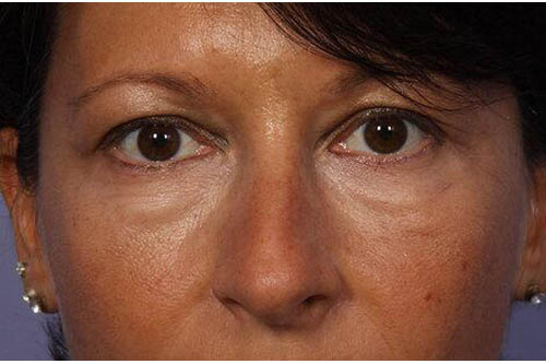 Eyelid Surgery Before & After Image