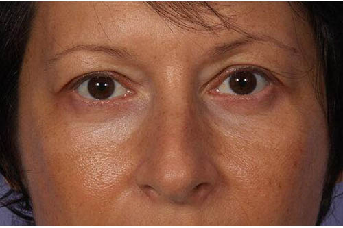 Eyelid Surgery Before & After Image