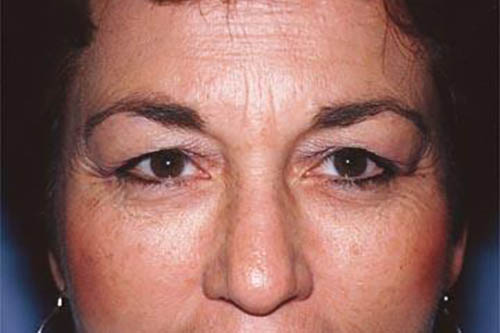 Eyelid Surgery Before & After Image