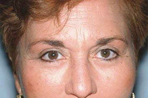 Eyelid Surgery Before & After Image