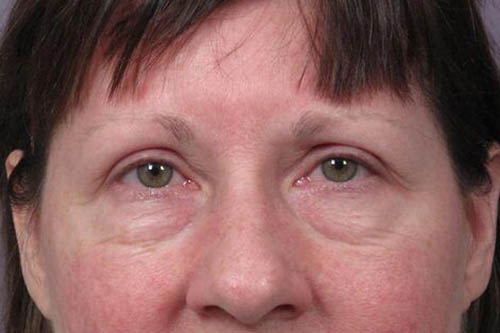 Eyelid Surgery Before & After Image