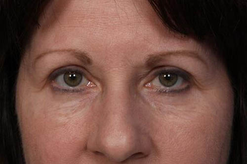 Eyelid Surgery Before & After Image