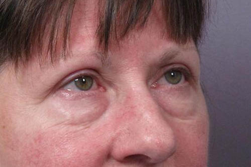 Eyelid Surgery Before & After Image